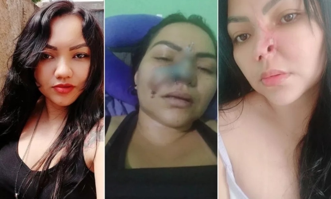 Mulher perde parte do nariz após cirurgia estética