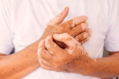 Vitiligo vai além da estética e pode comprometer a saúde mental de quem convive com a doença, explica especialista